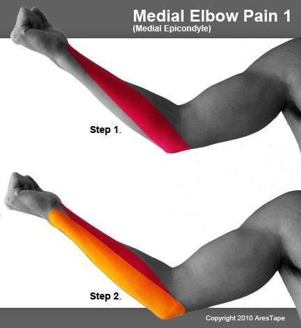 1_medial_elbow_pain